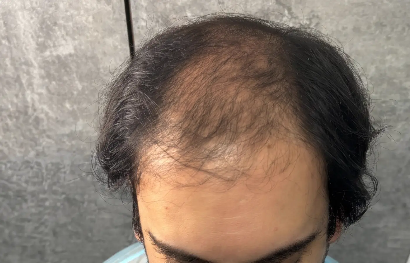Cuero cabelludo del paciente antes del injerto: coronilla y entradas despobladas